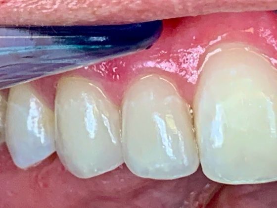 Smile Makeover Fix Ugly Composite Bonding -Black spots on bonding with micro leakage and recurrent decay-A limited smile makeover with Porcelain Veneers - After