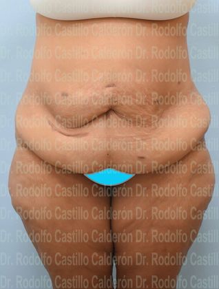 Post Bariatric Plastic Surgery: Belt Lipectomy + Lateral Thigh Lift - Before