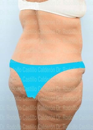 Post Bariatric Plastic Surgery: Belt Lipectomy + Lateral Thigh Lift - Before
