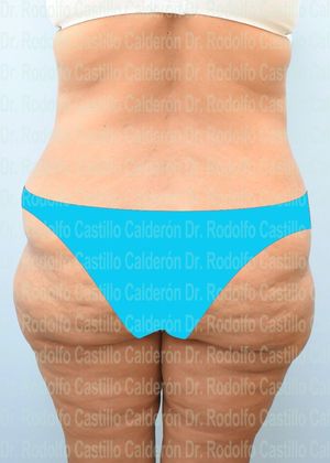 Post Bariatric Plastic Surgery Belt Lipectomy + Lateral Thigh Lift - Before