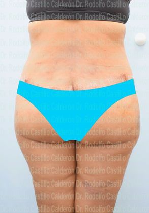 Post Bariatric Plastic Surgery Belt Lipectomy + Lateral Thigh Lift - After