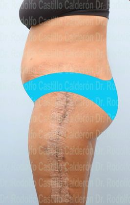 Post Bariatric Plastic Surgery: Belt Lipectomy + Lateral Thigh Lift - After Five Days