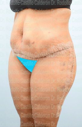 Post Bariatric Plastic Surgery: Belt Lipectomy + Lateral Thigh Lift - After five Days