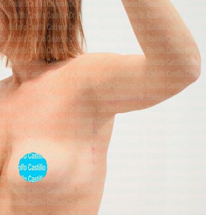 Post Bariatric Plastic Surgery: Secondary Arm Lift + Breast Augmentation - After