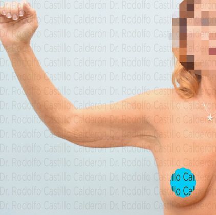 Post Bariatric Plastic Surgery Secondary Arm Lift + Breast Augmentation - Before