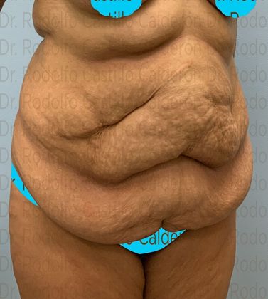 Post Bariatric Plastic Surgery: Belt Lipectomy in fleur de Lis five days from surgery - Before