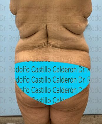 Post Bariatric Plastic Surgery: Belt Lipectomy in fleur de Lis five days from surgery - Before