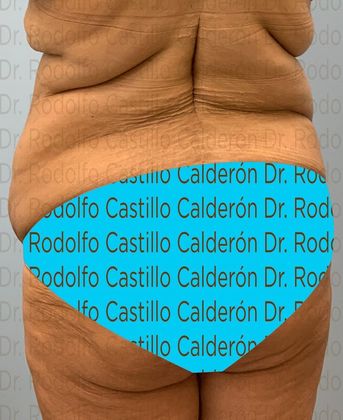 Post Bariatric Plastic Surgery: Belt Lipectomy in fleur de Lis five days from surgery - Before