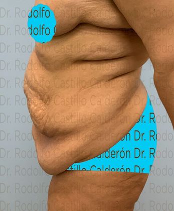 Post Bariatric Plastic Surgery: Belt Lipectomy in fleur de Lis five days from surgery - Before