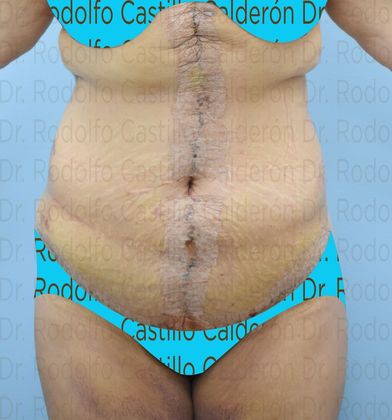 Post Bariatric Plastic Surgery: Belt Lipectomy in fleur de Lis five days from surgery - After five days
