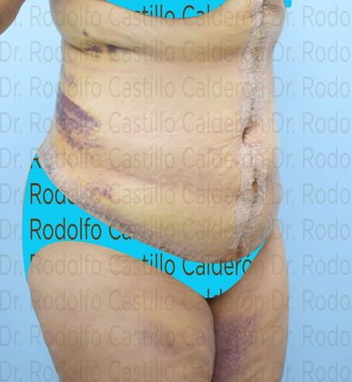 Post Bariatric Plastic Surgery: Belt Lipectomy in fleur de Lis five days from surgery - After five days