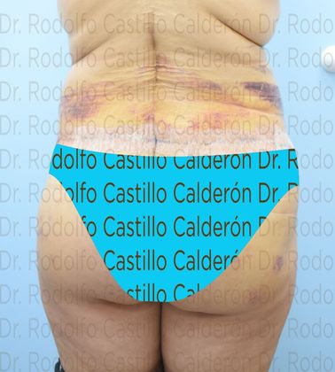 Post Bariatric Plastic Surgery: Belt Lipectomy in fleur de Lis five days from surgery - After five days