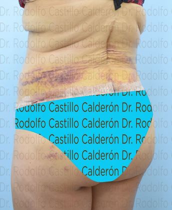 Post Bariatric Plastic Surgery: Belt Lipectomy in fleur de Lis five days from surgery - After five days