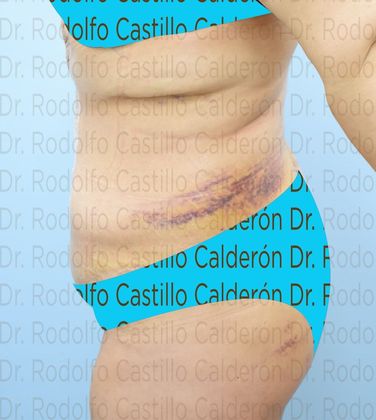 Post Bariatric Plastic Surgery: Belt Lipectomy in fleur de Lis five days from surgery - After five days