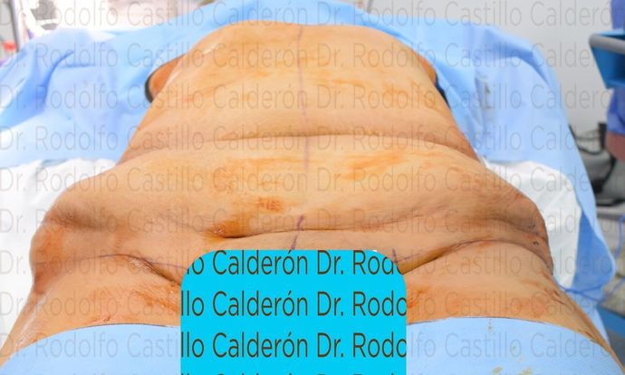 Post Bariatric Plastic Surgery: Belt Lipectomy in fleur de Lis five days from surgery - Before surgery