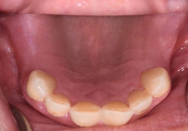 Dental Implants Case 17 - Victoria, TX - Before