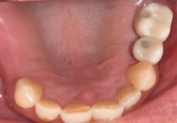 Dental Implants Case 17 - Victoria, TX - After