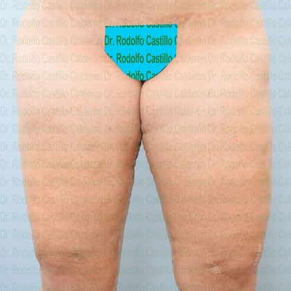 Thigh Lift: Case 1 - After five days