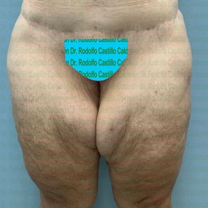 Thigh Lift: Case 1 - Before