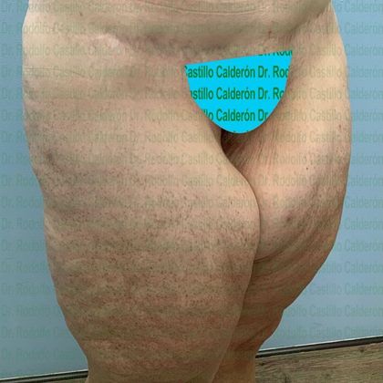 Thigh Lift: Case 1 - Before