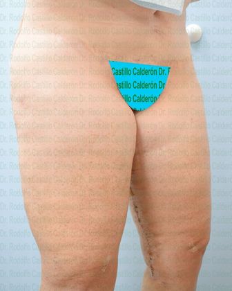 Thigh Lift: Case 1 - After five days