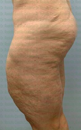 Thigh Lift: Case 1 - Before