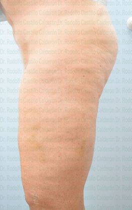 Thigh Lift: Case 1 - After five days