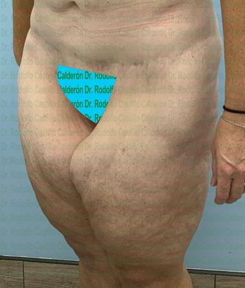 Thigh Lift: Case 1 - Before