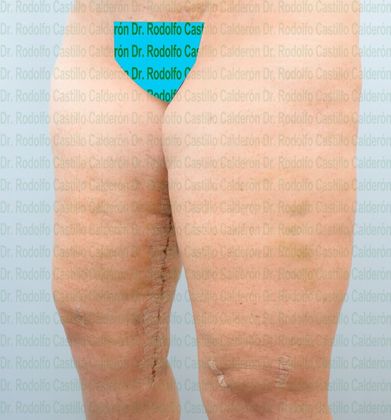 Thigh Lift: Case 1 - After five days