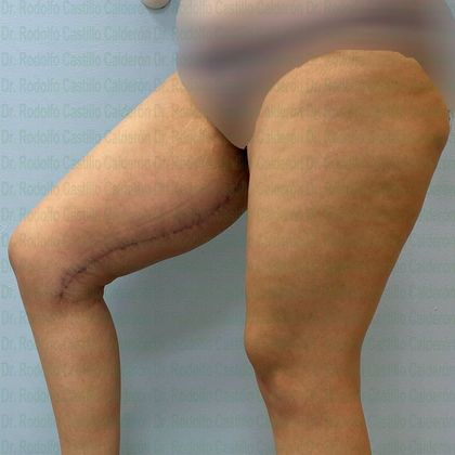 Thigh Lift: Case 2 - After