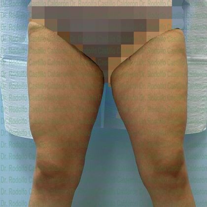Thigh Lift: Case 2 - After