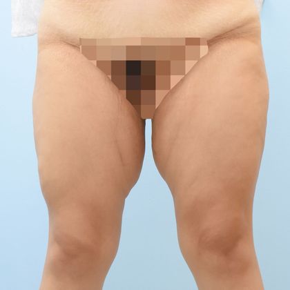 Thigh Lift: Case 2 - Before
