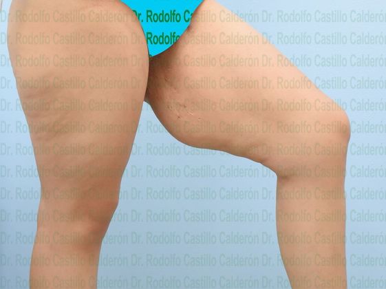 Thigh Lift: Case 2 - Before