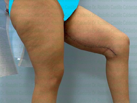 Thigh Lift: Case 2 - After
