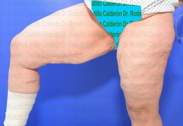 Thigh Lift: Case 3 - Before