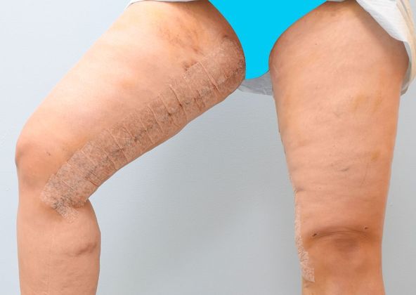 Thigh Lift: Case 3 - After five days