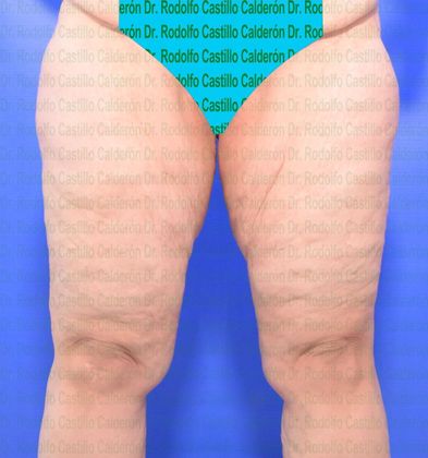 Thigh Lift: Case 3 - Before