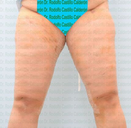 Thigh Lift: Case 3 - After five days