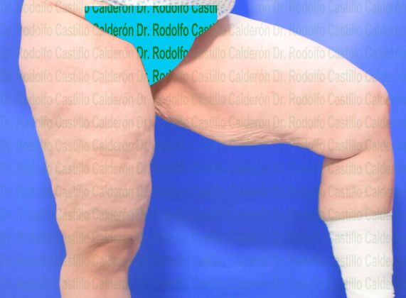 Thigh Lift: Case 3 - Before