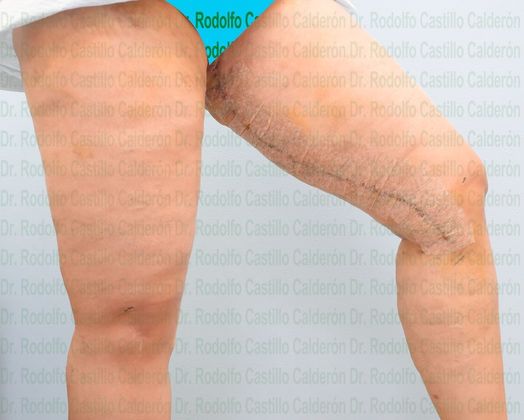 Thigh Lift: Case 3 - After five days