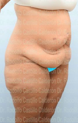 Thigh Lift: Case 4 - Belt Lipectomy + Lateral Thigh Lift - Before