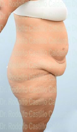 Thigh Lift: Case 4 - Belt Lipectomy + Lateral Thigh Lift - Before