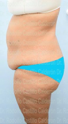 Thigh Lift: Case 4 - Belt Lipectomy + Lateral Thigh Lift - Before