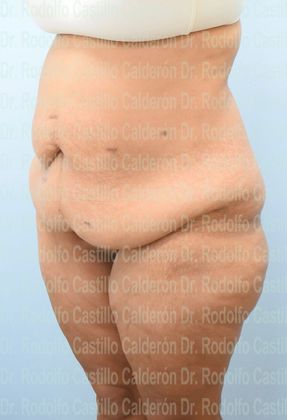Thigh Lift: Case 4 - Belt Lipectomy + Lateral Thigh Lift - Before
