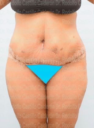 Thigh Lift: Case 4 - Belt Lipectomy + Lateral Thigh Lift - After five days