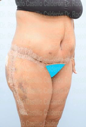 Thigh Lift: Case 4 - Belt Lipectomy + Lateral Thigh Lift - After five days