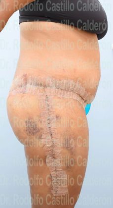 Thigh Lift: Case 4 - Belt Lipectomy + Lateral Thigh Lift - After five days