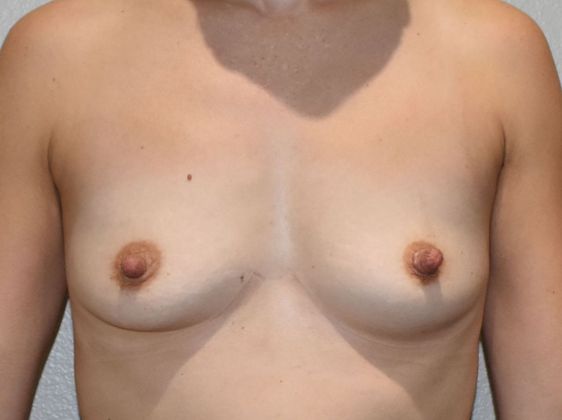 Breast Augmentation Case 724 - Before