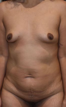 Mommy Makeover Case 208 - Before