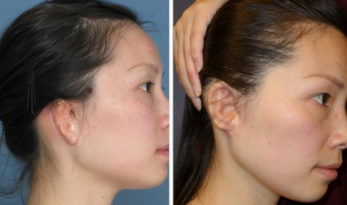 Correcting Prior Surgeries: Patient 7 - 26 year old after multiple prior surgeries, 2 years after Medpor revision.